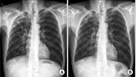 Fig. 1. Chest  X-ray  showing  cavitated  pulmonary   tu-berculosis  in  the  right  upper  lobe,  initial  (A)  and  after  4  months  (B).