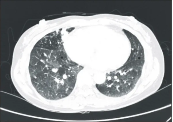 Fig.  1.  The  chest  HRCT  shows  bronchiectasis,  bronchiolitis  and  subsegmental  atelectasis  in  right  middle  lobe,  and  subtle  bronchiolectasis  and  fibrotic  band  in  both  lower  lobe.