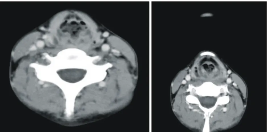 Fig.  2.  CT  findings.  CT  scan  of  the  neck  showed  diffuse  soft  tissue  edema  around  the 