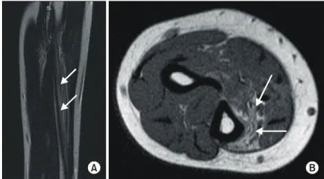 Fig.  1.  MRI  of  forearm  (T2  weighted  image)  shows  increased  signal  intensity  on  right  flexor  digitorum  profundus  muscle  (arrows)