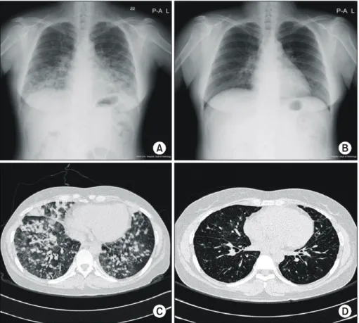 Fig.  2. (A)  Diffuse  nodules  were  noted  in  both  lungs  with  lower  lobe  predominance  at  the  time  of  admis- admis-sion