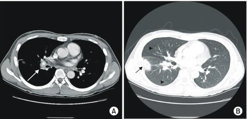 Fig.  1.  Chest  computed  tomography  with  mediastinal  window  setting  (A)  and  lung  window  setting  (B)