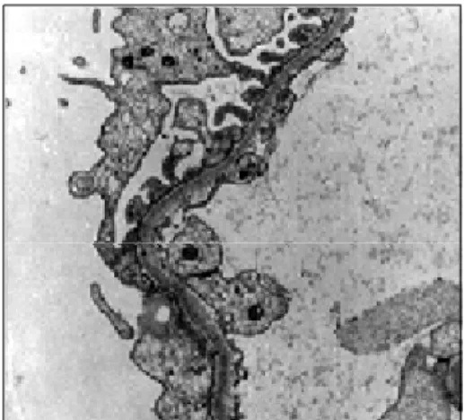 Fig.  2.  Ultrastructurally,  the  glomerular  basement  membrane  was  markedly  attenuated  (original  magnification  × 21,000).