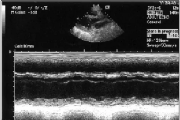 Fig.  2.  M-mode  echocardiogram  before  treatment  shows  decreased  left  ventricular  contractility  (ejection  fraction=24.7%)  without  pericardial  effusion.