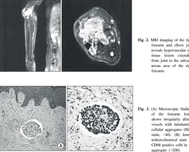 Fig.  2.  MRI  imaging  of  the  right  forearm  and  elbow  joint  reveals  hypervascular  soft  tissue  lesion  extending  from  joint  to  the   subcuat-neous  area  of  the  right  forearm.