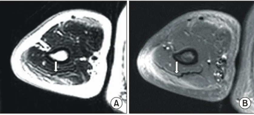 Fig.  1.  Gadolinium-enhanced  MRI  ((A)  T1  weighted  image,  (B)  Fat  suppression  image); 