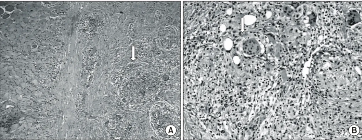 Fig.  2.  A  biopsy  specimen  obtained  from  the  triceps  muscle  of  a  patient  demonstrated  non-caseating  granulomas  with  multinucleated  giant  cells  infiltrating  along  the  fascial  plane  (H&amp;E  stain;  (A)  magnification  ×40,  (B)  ×10