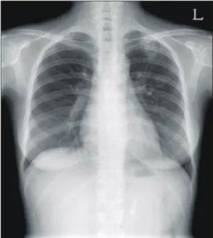 Fig.  1.  Chest  X  ray  presents  cavitating  nodule  in  Lt.  upper  lobe.
