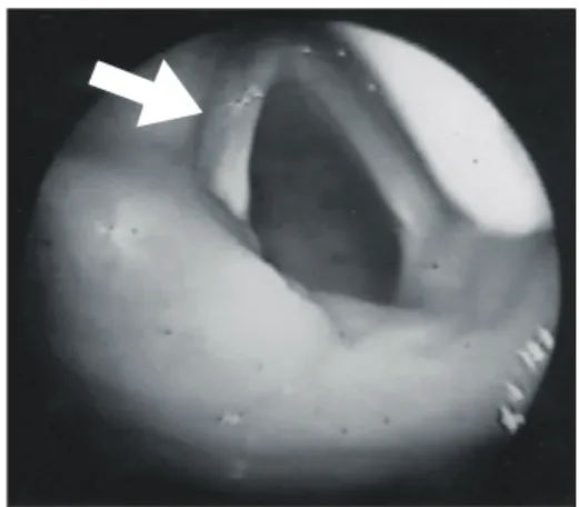 Fig.  1.  Initial  laryngoscopic  examniation  showed  lateral  fixation  of  the  left  vocal  cord  (arrowed).