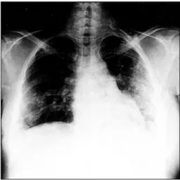 Fig.  2.  Posteroanterior  view  of  the  chest  shows  diffuse  subcutaneous  calcification  of  the  thoracic  wall.