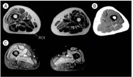 Fig.  1.  Polymyositis  as  seen  in  magnetic  resonance  images  of  thigh.  (A)  Axial  T2-weighted  fast  spin  echo  MR  image  shows  bilateral  increased  signal  intensity  representing  edema  in  the  vastus  lateralis,  intermedius,  medialis,  