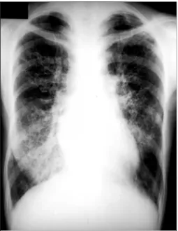 Fig.  1.  Chest  PA  shows  diffuse  reticulointerstitial  marking  in  both  lung  fields.