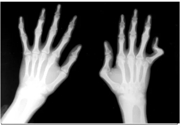 Fig.  3.  High  resolution  CT  (HRCT)  scan  at  basal  lung  level  shows  honeycombing  and  ground-glass   opac-ities  in  both  lung  fields.