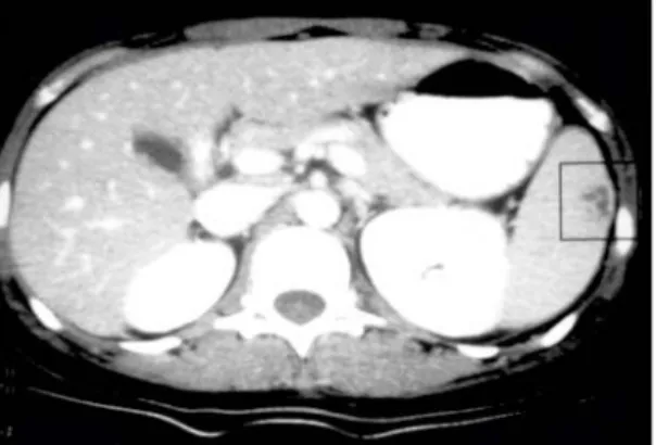 Fig.  2.  99m Tc-RBC  SPECT  (Single  photon  emission  com- com-puterized  tomography)  images  in  three-dimensional  orientation  show  a  wedge-shaped  area  of  decrease  uptake  in  the  upper  portion  of  the  spleen  superior  to  the  hilum  (arr