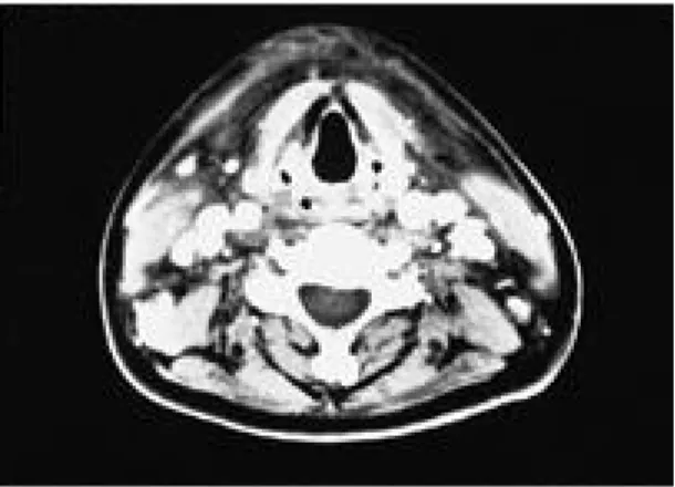 Fig. 1. The bone marrow section shows increased number of polynormoblast which have irregular cytoplasm