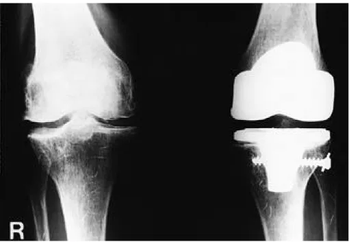Fig. 1. Plain knee X-ray shows linear calcification within menisci and articular hyaline  cartilage in right knee