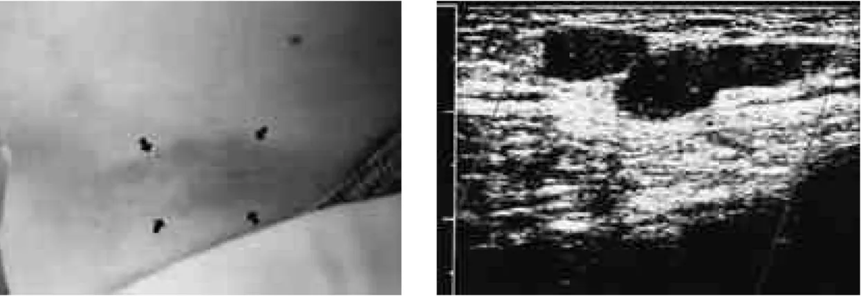 Fig. 1. Abdominal mass located in the left lower abdomen near inguinal area. Mass was oval shaped, movable, tender with slightly hard consistency, measuring 5×7cm size.