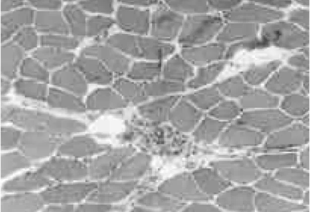 Fig. 3. Mass tissue shows neoplastic glandular structures and necrosis (Hematoxylin-eosin stain ×2 0 0 ) .