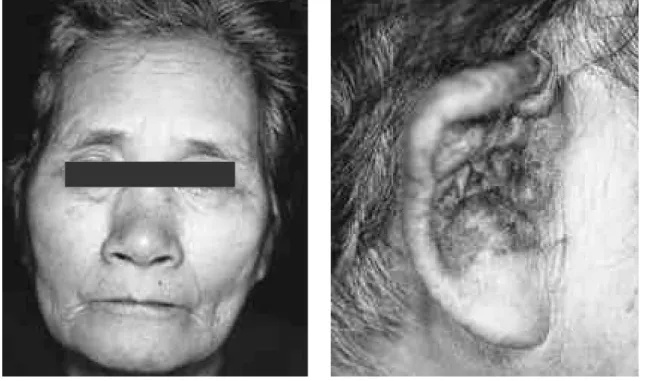 Fig. 1. The saddle nose deformity is caused by damage of the nasal bridge.
