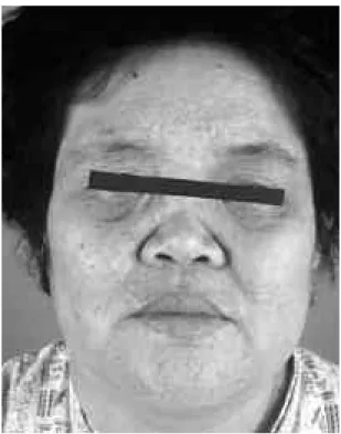 Fig. 1. Saddle nose deformity in Wegener’s gran- gran-u l o m a t o s i s .