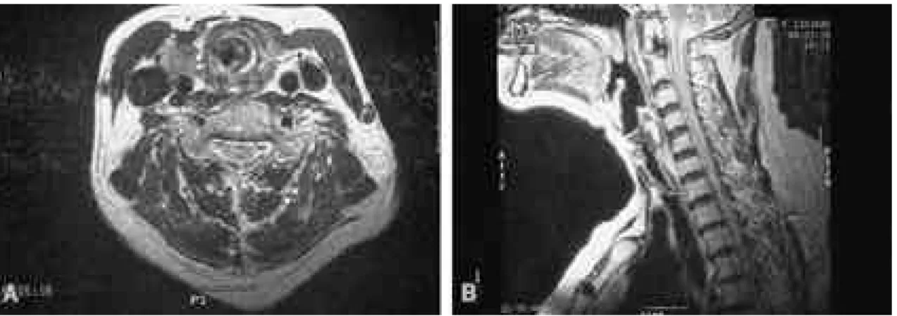 Fig. 3. Magnetic resonance imaging of the neck. (A) An axial image reveals marked nodular narrow- narrow-ing(closed arrow) of upper trachea