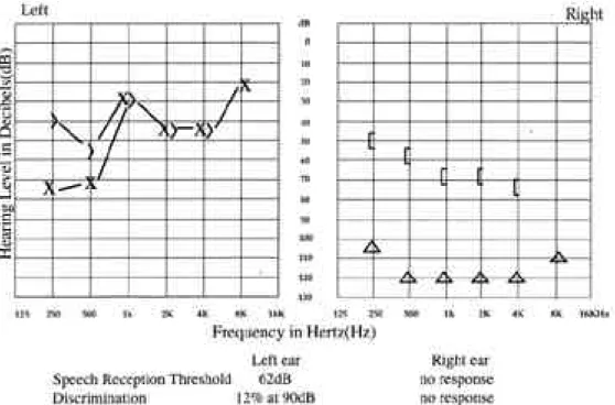Fig. 1. Pure tone audiogram at admission
