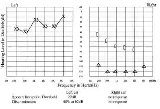 Fig. 2. Pure tone audiogram 10days after high dose corticosteroid treatment