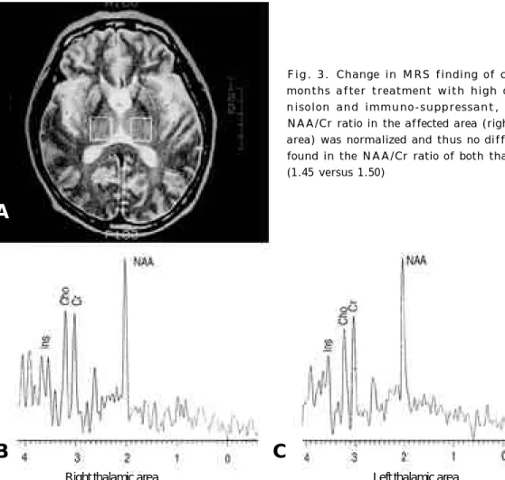 Fig. 3. Change in MRS finding of case 2. Six months after treatment with high dose  pred-nisolon and immuno-suppressant, decreased NAA/Cr ratio in the affected area (right thalamic area) was normalized and thus no difference was found in the NAA/Cr ratio o