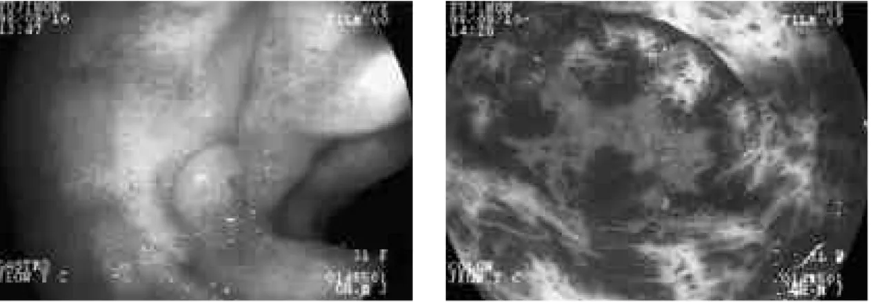 Fig. 1. Gastroscopy shows red patches and edema from duodenal bulb to 2nd portion