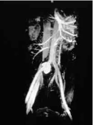 Fig. 1. Radionuclide venoraphy shows non-visual- non-visual-ization of popliteal vein and deep femoral veins with multiple and irregular  collater-al circulations in the left leg