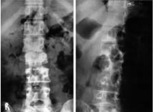 Fig. 1. Anteroposterior and lateral view of L-spine showed L1 and L2 body compression  frac-ture with cortical end plate irregularity and L1-L2 intervertebral space narrowing.