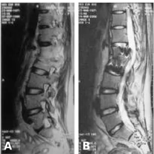 Fig. 2. L-spine MRI (T2 weighted sagittal images) : (A) preoperative view showed compression fracture with angular deformity of L1 and L2 bodies, intervertebral disc deformity and compression of cauda equina
