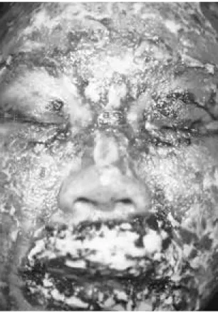 Fig. 2. On her face, especially in perioral and periorbital area 