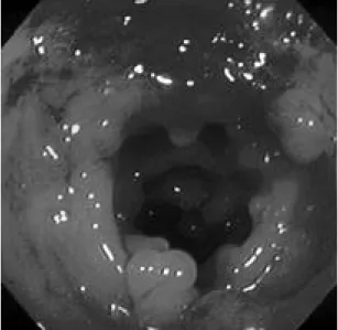 Fig. 4. Colonoscopic biopsy shows focal distorted crypt architecture with moderate degree of mucosal inflammation, lymphoid aggregates, and cryptitis with crypt abscess (black arrow) (H&amp;E stain, ×2 0 0 ) .