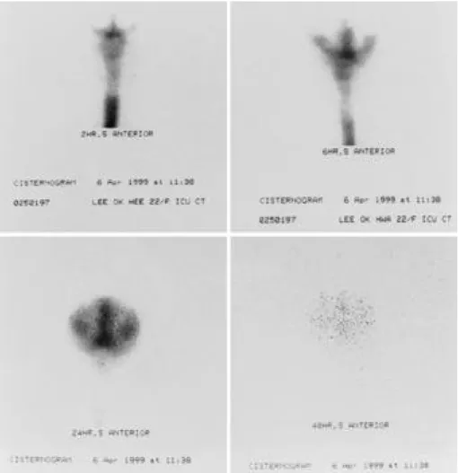 Fig. 2. RI cisternography revealed persistent ventricular activity and delayed clearance