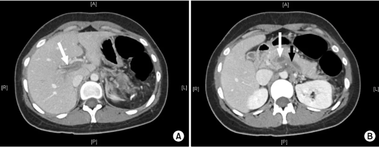 Fig. 1. Contrast  enhanced  abdominal  pelvic  computed  tomography  scan  on  the  first  day