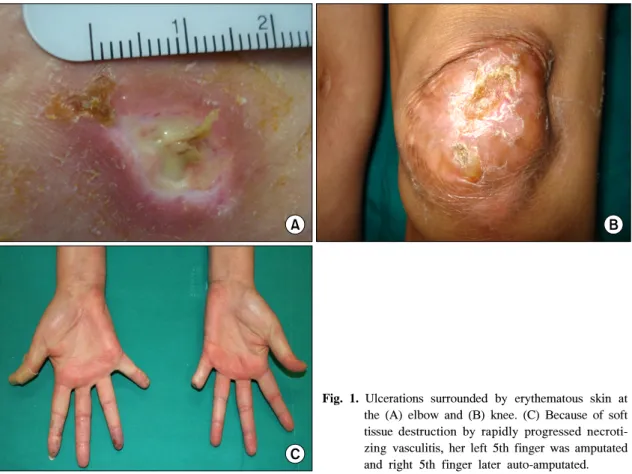Fig. 1. Ulcerations  surrounded  by  erythematous  skin  at  the  (A)  elbow  and  (B)  knee