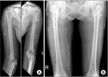 Fig. 2. Simple  X-rays  show  diffuse  soft  tissue  calcifications  in  both  arms  (A)  and  legs  (B).