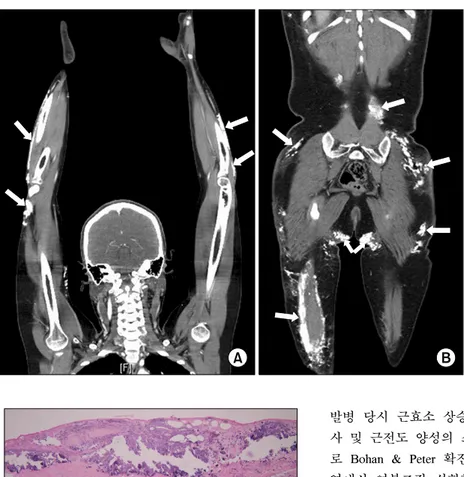Fig. 3. Computed  tomography  images  show  diffuse  subcutaneous  and   mu-scular  calcifications  (arrows)  in  the  both  arms  (A),  buttock  and  lower  legs  (B).