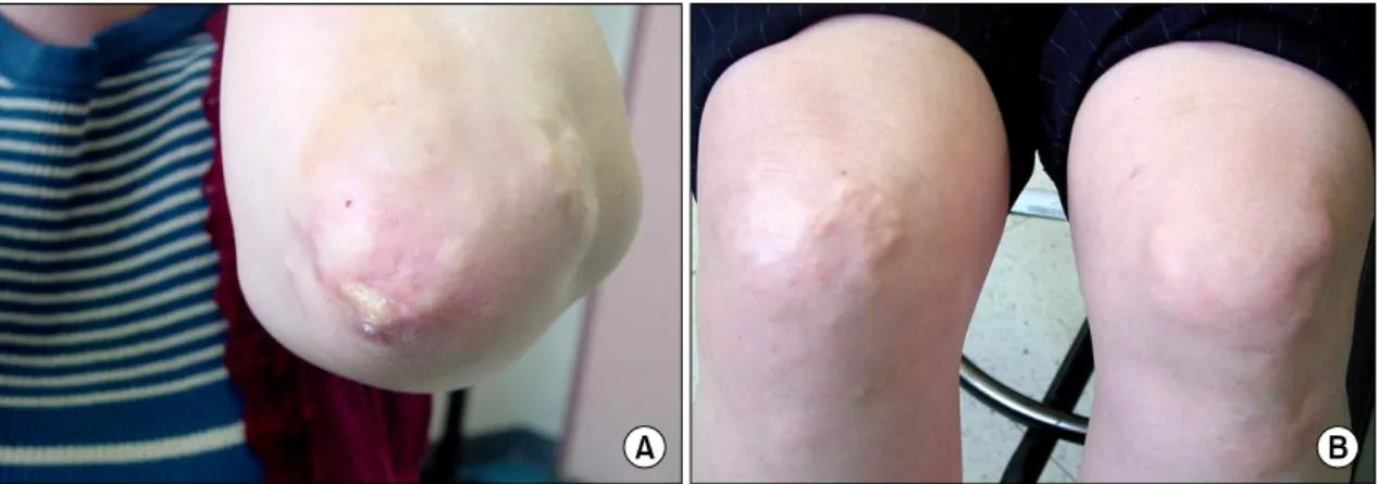 Fig.  1.  There  are  multiple  firm  flesh  colored  nodules  on  the  left  elbow  (A)  and  both  knee  (B).