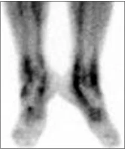 Fig.  1.  In  3-phase  bone  scintigraphy,  blood  pool  image  shows  increased  perfusion  in  the  periarticular  areas  of  both  ankles.증      례    환   자:  33세  여자     주   소:  1개월전부터 발생한  양측 발목의  통증과  부종     병    력:  평소  건강히  지내던  환자로  내원  1달전부터  양측  