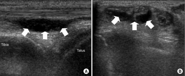 Fig.  3.  The  pathology  of  mediastinal  lymph  node  shows  multiple  non-caseating  granulomatous  inflammation,  suggestive  of  sarcoidosis