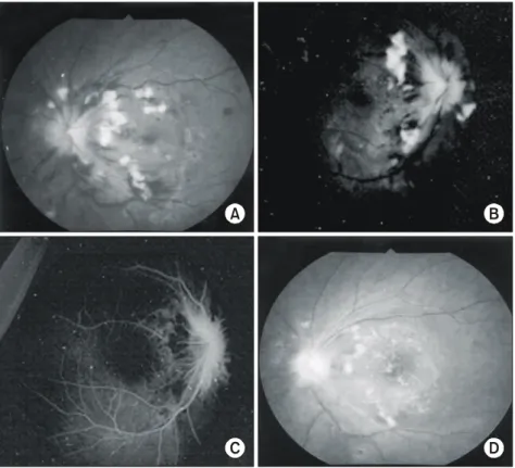 Fig.  2.  Left  eye,  before  treatment;  Fundoscopic  examination  showed  multiple  hemorrhage,  papil- papil-ledema  and  macular  edema  (A)