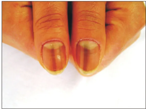 Fig.  1.  Melanonychia  affects  left  fingernails. Fig.  3.  Close-up  view  of  the  thumbnails.