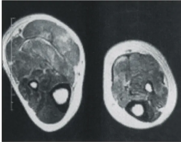 Fig.  1.  MRI  showed  diffusely  increased  signal  intensity  and  swelling  of  both  lower  legs