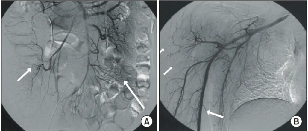 Fig.  3.  Arteriography  showing  multiple  small  saccular  aneurysms  in  ileocolic  artery  and  jejunal  artery  (A)  and  muscular  branches  in  the  left  leg  (B).