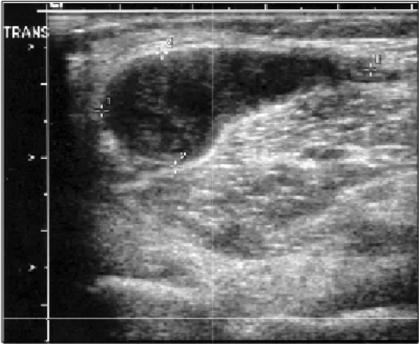 Fig.  2.  Microscopic  finding  showed  fibrous  tissue  with  marked  proliferated  blood  vessels,  mild  infiltration  of  inflammatory  cells,  necrotic  areas