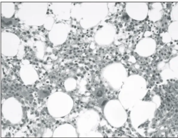 Fig.  3.  Biopsy  of  bone  marrow  shows  numerous  mega- mega-karyocytes  (H&amp;E,  ×400).