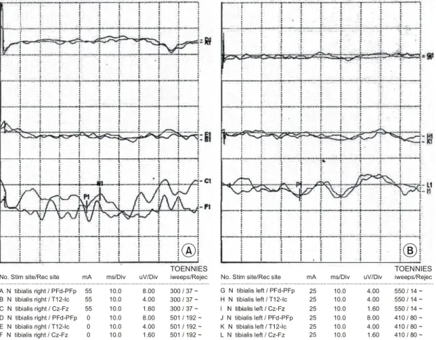 Fig.  1.  Nerve  conduction  velocity  (A)  Right  (B)  Left.  Both  of  N.  fibularis  and  N