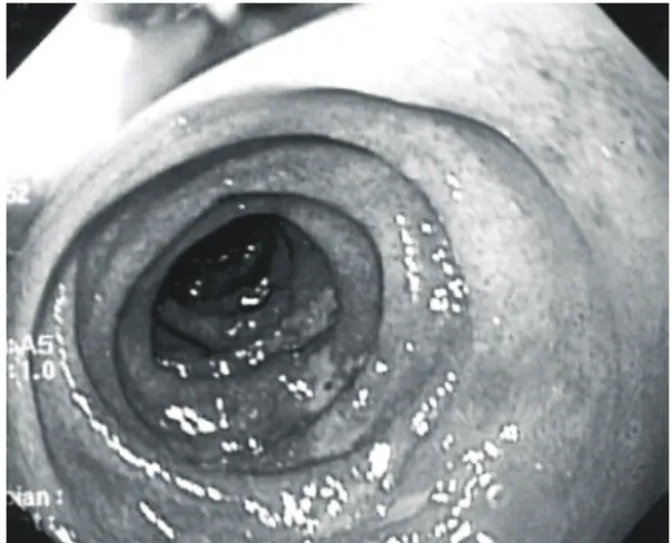 Fig.  1.  Endoscopic  view  of  duodenum  showing  mul- mul-tiple  erosions  and  shallow  ulcerations  on  the  2 nd   portion.
